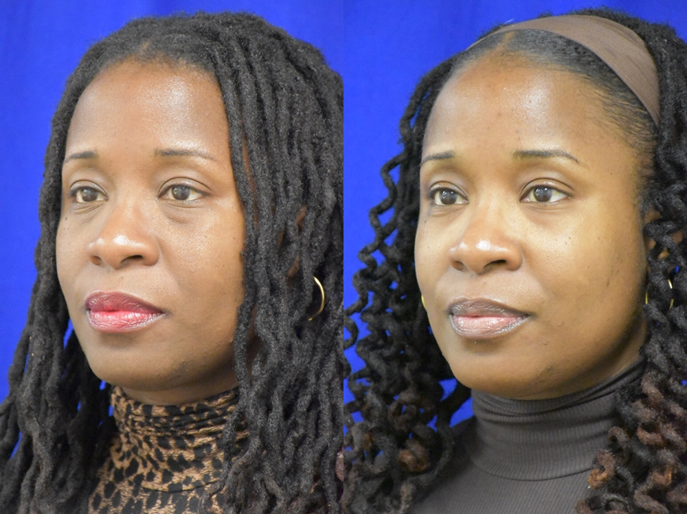 Lower Blepharoplasty with fat transposition before and after photo by Dr. Sean Weiss in Metairie LA