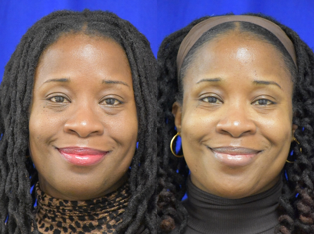 Lower Blepharoplasty with fat transposition before and after photo by Dr. Sean Weiss in Metairie LA