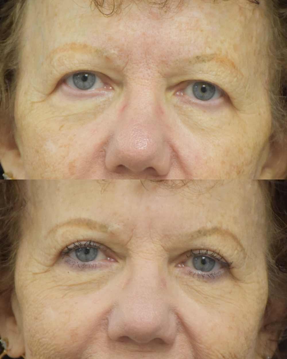 Upper Blepharoplasty before and after photo by Dr. Sean Weiss in Metairie LA