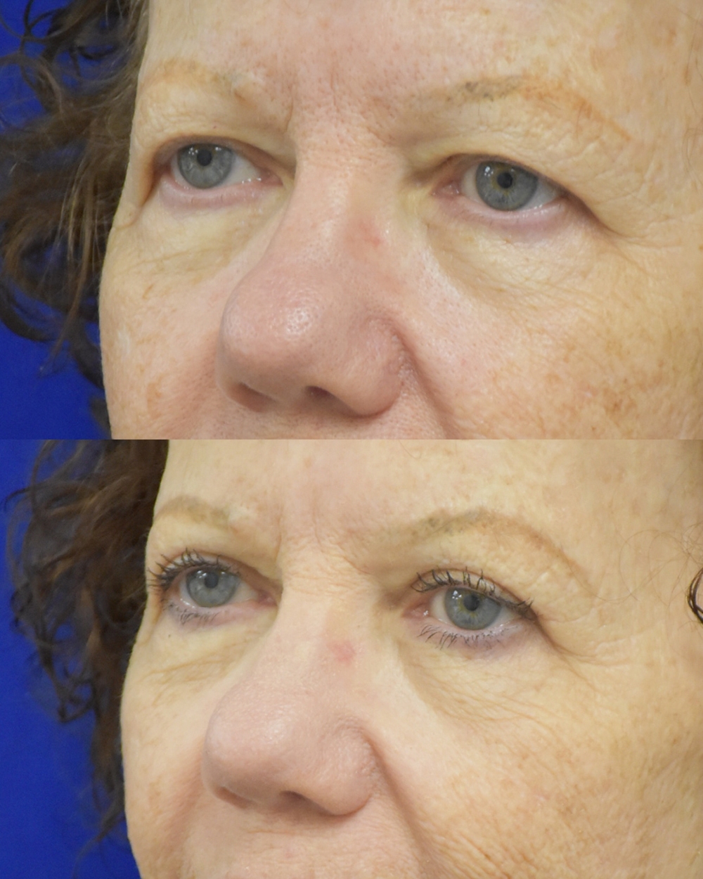 Upper Blepharoplasty before and after photo by Dr. Sean Weiss in Metairie LA