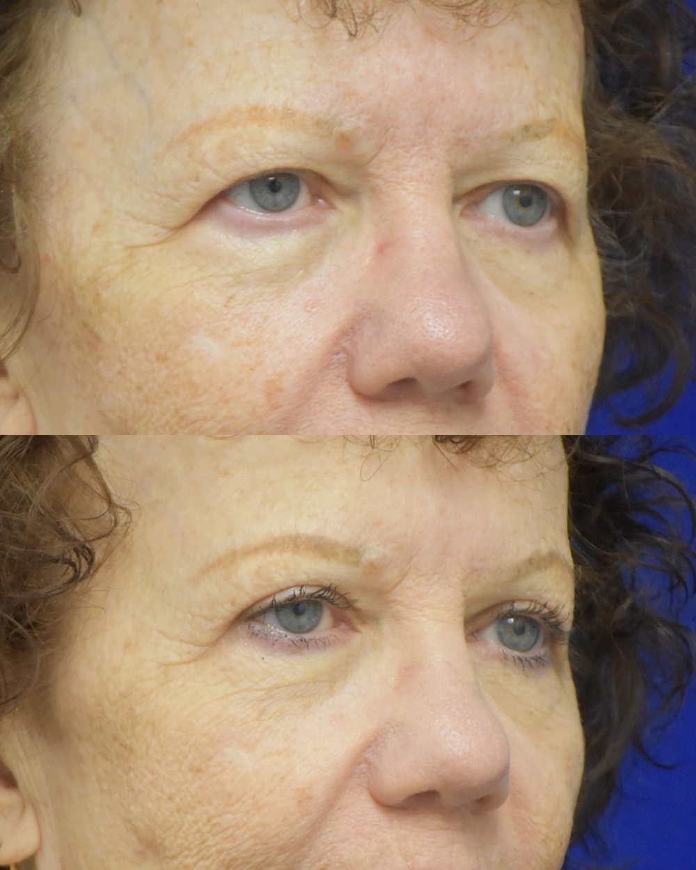 Upper Blepharoplasty before and after photo by Dr. Sean Weiss in Metairie LA